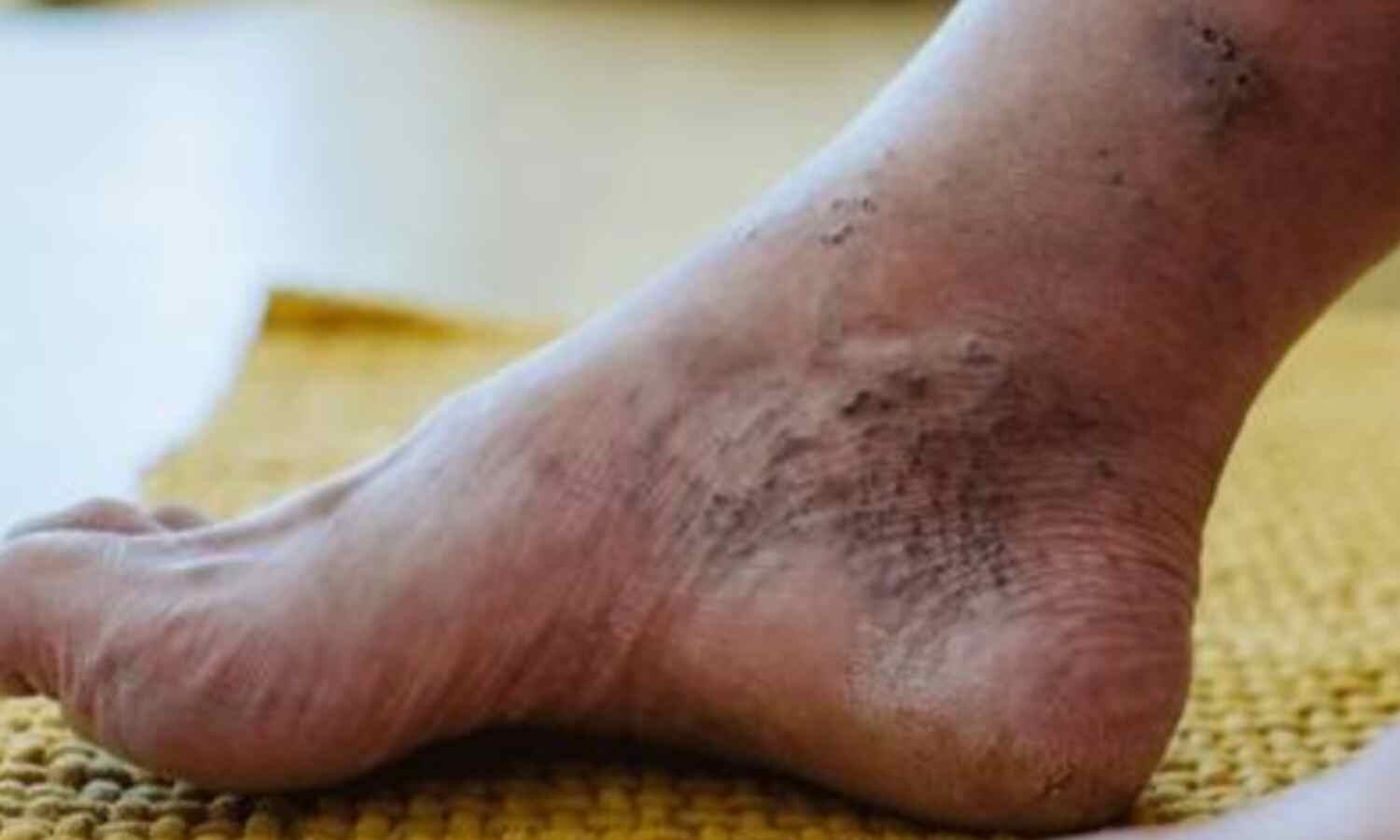 डायबिटीज से संबंधित गंभीर समस्या, डायबिटिक न्यूरोपैथी