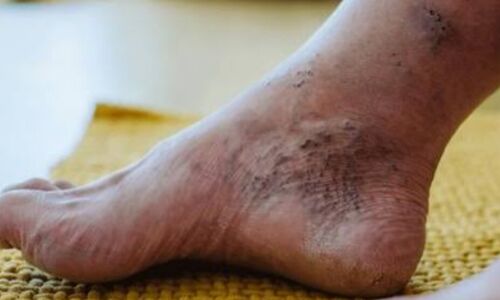 डायबिटीज से संबंधित गंभीर समस्या, डायबिटिक न्यूरोपैथी डायबिटीज से संबंधित गंभीर समस्या, डायबिटिक न्यूरोपैथी