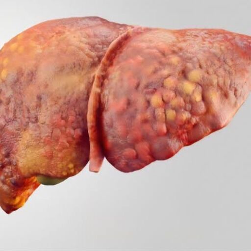 फैटी लीवर एक आम समस्या, फैटी लीवर एक आम समस्या,