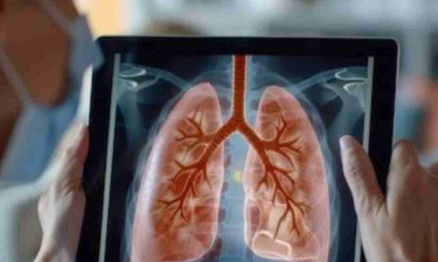 भारत की टीबी के खिलाफ लड़ाई एक महत्वपूर्ण उपलब्धि