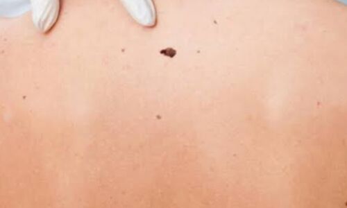 त्वचा कैंसर के लक्षण, कारण और बचाव के उपाय