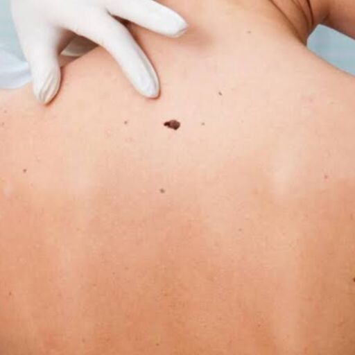 त्वचा कैंसर के लक्षण, कारण और बचाव के उपाय