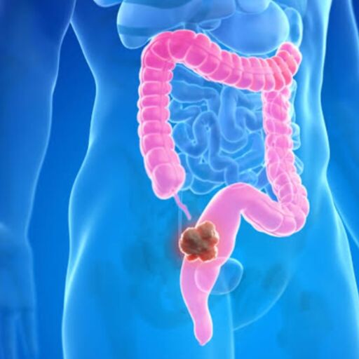 рдХреЛрд▓реЛрд░реЗрдХреНрдЯрд▓ рдХреИрдВрд╕рд░, рдорд┐рд▓реЗрдирд┐рдпрд▓реНрд╕ рдФрд░ рдЬрди-рдПрдХреНрд╕ рдХреЗ рд▓рд┐рдП рдЙрднрд░рддрд╛ рд╣реБрдЖ рдЧрдВрднреАрд░ рд╕реНрд╡рд╛рд╕реНрдереНрдп рд╕рдВрдХрдЯ рдХреЛрд▓реЛрд░реЗрдХреНрдЯрд▓ рдХреИрдВрд╕рд░, рдорд┐рд▓реЗрдирд┐рдпрд▓реНрд╕ рдФрд░ рдЬрди-рдПрдХреНрд╕ рдХреЗ рд▓рд┐рдП рдЙрднрд░рддрд╛ рд╣реБрдЖ рдЧрдВрднреАрд░ рд╕реНрд╡рд╛рд╕реНрдереНрдп рд╕рдВрдХрдЯ