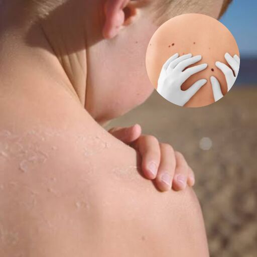 рддреНрд╡рдЪрд╛ рдХреИрдВрд╕рд░ рдХреЗ рд▓рд┐рдП рд╕реВрд░рдЬ рдХреА рд╣рд╛рдирд┐рдХрд╛рд░рдХ рдпреВрд╡реА (UV) рдХрд┐рд░рдгреЗрдВ рдХрд┐рддрдиреА рдЬрд┐рдореНрдореЗрджрд╛рд░ рддреНрд╡рдЪрд╛ рдХреИрдВрд╕рд░ рдХреЗ рд▓рд┐рдП рд╕реВрд░рдЬ рдХреА рд╣рд╛рдирд┐рдХрд╛рд░рдХ рдпреВрд╡реА (UV) рдХрд┐рд░рдгреЗрдВ рдХрд┐рддрдиреА рдЬрд┐рдореНрдореЗрджрд╛рд░