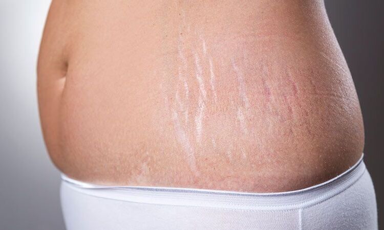 प्रेगनेंसी के बाद लूज स्किन को टाइट बनाते है ये टिप्स