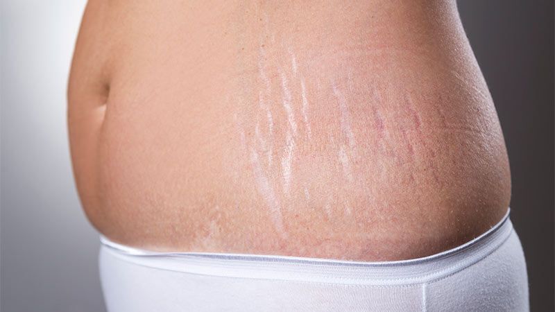 प्रेगनेंसी के बाद लूज स्किन को टाइट बनाते है ये टिप्स