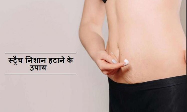 स्ट्रेच मार्क्स ख़त्म करने के ये हैं बेहद सरल तरीके, नहीं कम होगी सुंदरता