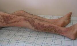 सावधान यूरोप की ये बीमारी पहुंच चुकी है यूपी