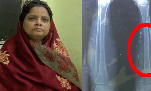 32 सालों से शरीर के अंदर ये चीज़ लेकर जी रही थी महिला, पति ने X-Ray देखा तो वह बेहोश हो गया.