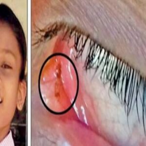 लड़की की आंखों से जब निकली इतनी ज्यादा चींटियां, देखते ही दंग रह गए डॉक्टर