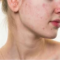 4 टिप्स करें फॉलो, रातभर में पिम्पल्स होंगे गायब... 4 टिप्स करें फॉलो, रातभर में पिम्पल्स होंगे गायब...