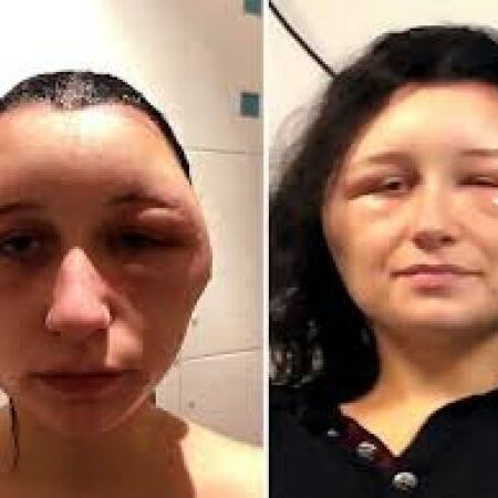 बालों में कलर लगाने के बाद महिला के चेहरा का हो गया ऐसा हाल, देखकर हो जाएंगे हैरान