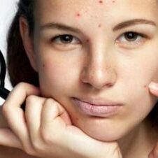 गर्मी में पिम्पल्स को दूर करेगा पानी, बस मिलाएं ये चीज़ें