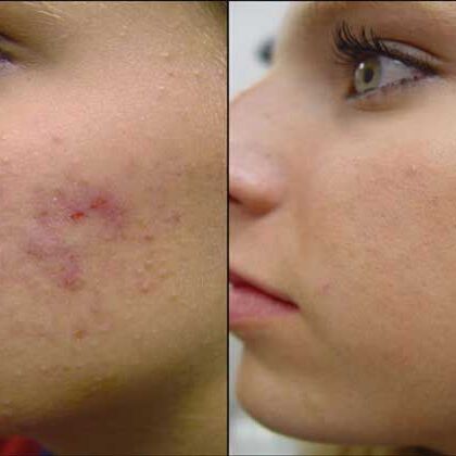 आप भी दूर कर सकते है, पिम्पल से होने वाले गड्ढों को...