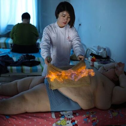 यहाँ मोटापे को कम करने के लिए लगायी जाती है शरीर पर आग !