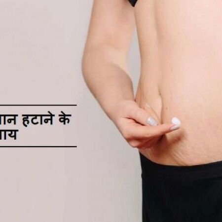 स्ट्रेच मार्क्स ख़त्म करने के ये हैं बेहद सरल तरीके, नहीं कम होगी सुंदरता स्ट्रेच मार्क्स ख़त्म करने के ये हैं बेहद सरल तरीके, नहीं कम होगी सुंदरता