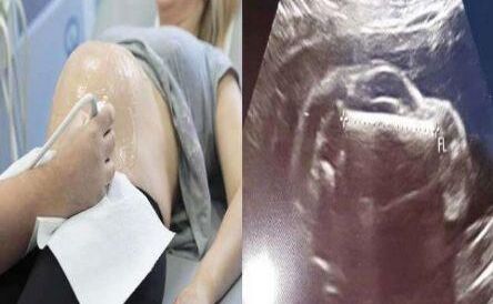 इस महिला के पेट में बच्चा नहीं बल्कि पल रही थी ये भयानक चीज...