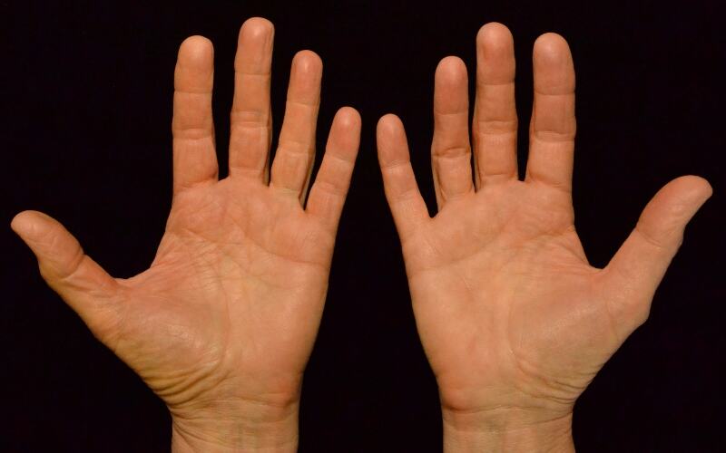 हथेली बताती है किस रोग से हो सकते हैं परेशान