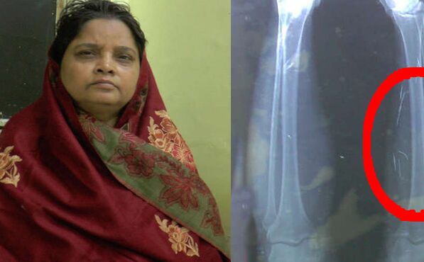 32 सालों से शरीर के अंदर ये चीज़ लेकर जी रही थी महिला, पति ने X-Ray देखा तो वह बेहोश हो गया.